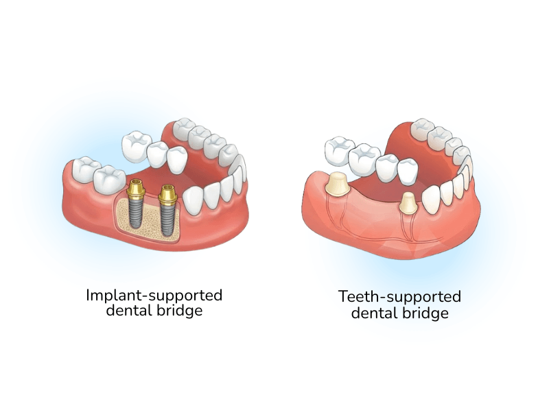 dental bridge types: dental bride supported by implants and supported by teeth