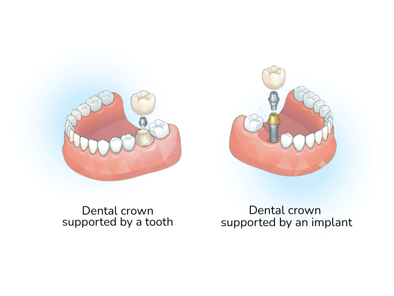 dental crown types