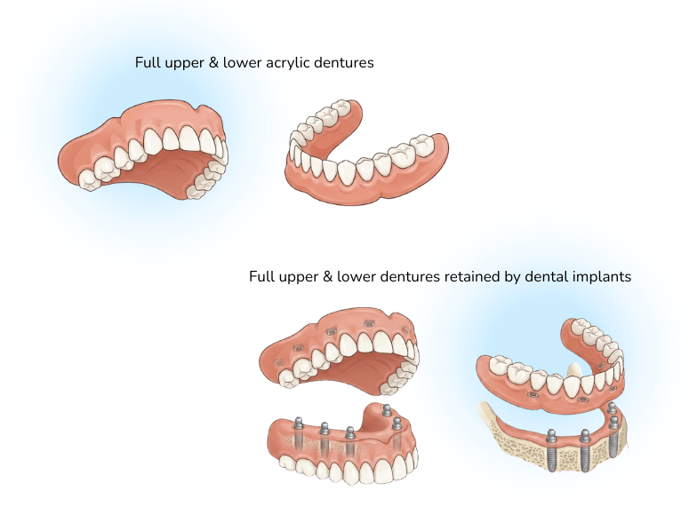 full lower and upper denture types