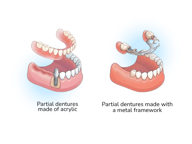 partial dental dentures