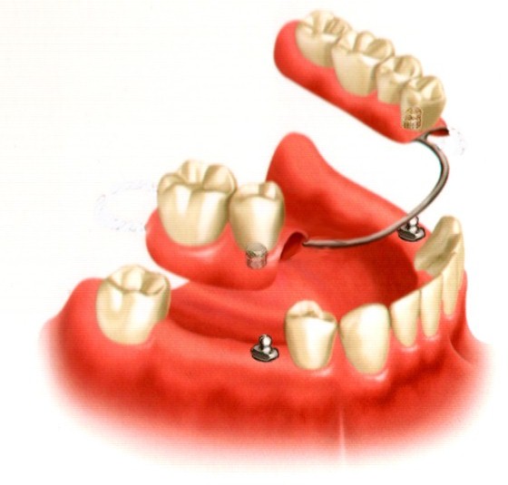 partial denture 2