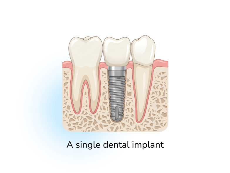 single dental implant