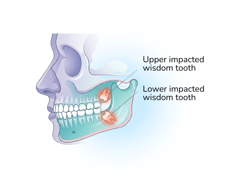 wisdom tooth removal